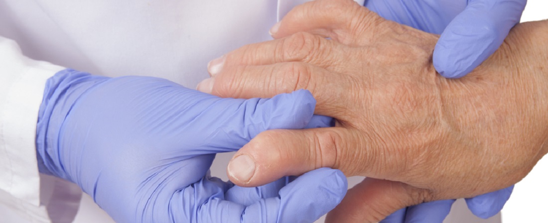 Artriit Rent valu liigestes Osteokondroos kaera ravi