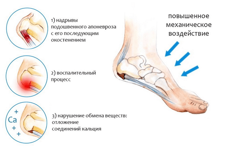 Jala ja ravi liigeste artroos Slovakkia artroosi ravi