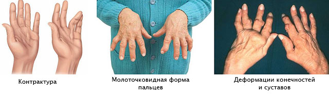 Koigi liigeste artriit Kas liigesed kahjustavad osteokondroosiga