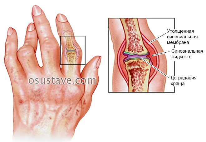 Harjade liigeste artriit ja peatus Tugev valu liigeste peatus