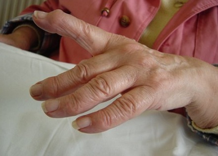 Reumatoidartriidi sormede ennetamine Spin valutab hagu
