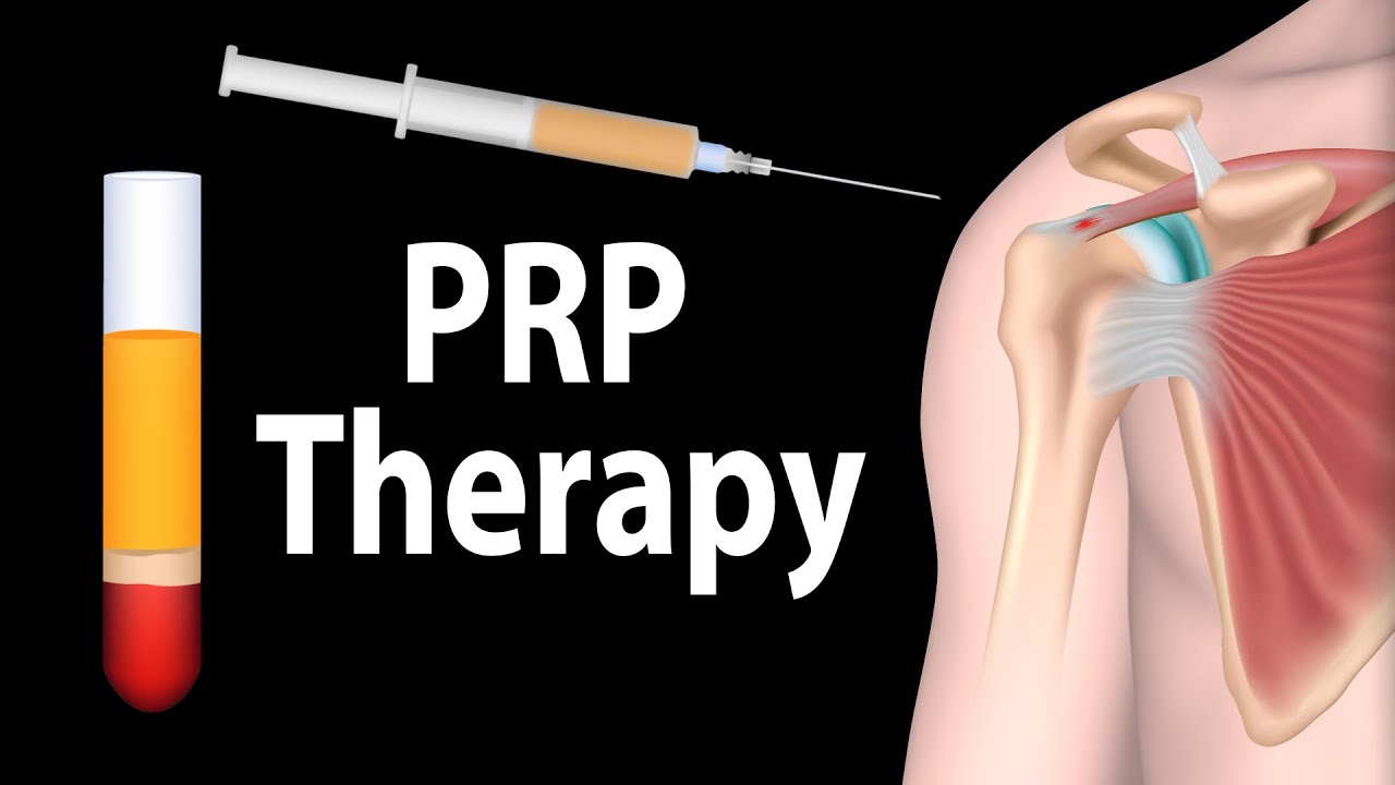 PRP-ravi liigeste ravi Ray-eksklusiivsete liigeste ravi