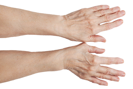 hakkavad haiget tegema kate sormedest, mida teha Mida teha sorme artriidiga