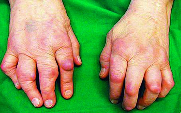 liigeste sormede artroos ravida Vedelik kuunarnukis vigastuse ajal