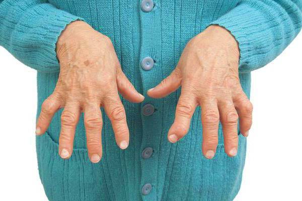 Artriit kuunarnuki liigeste ravi
