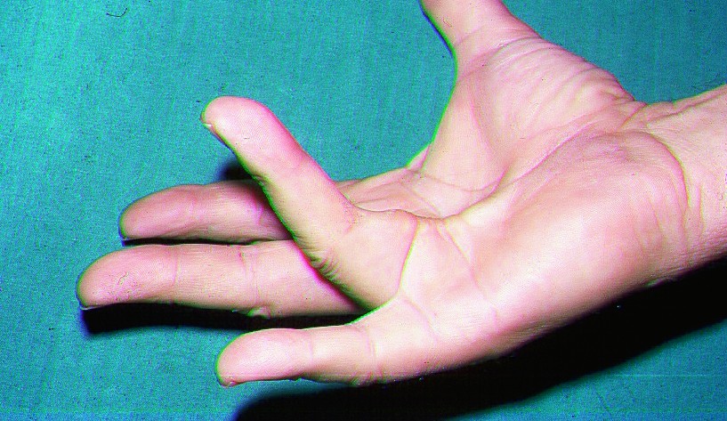 Artriit 3 sorme vasaku kaega SuperCooling liigeste poletik