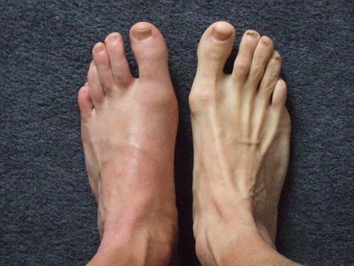 Jala sormede liigeste haigused puusaliigese hip kondides