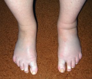 Folk viisid jala liigeste raviks Voib olla poidla artriit