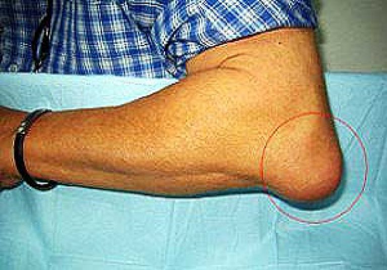 Kuunarnuki liigeste ravi Bursiit Artroosi tema ravi ennetamine