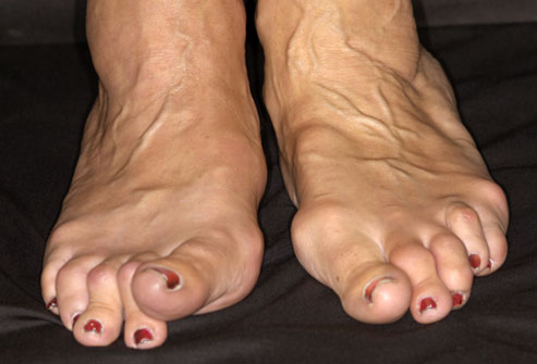 Foot liigeste haiguse ravi