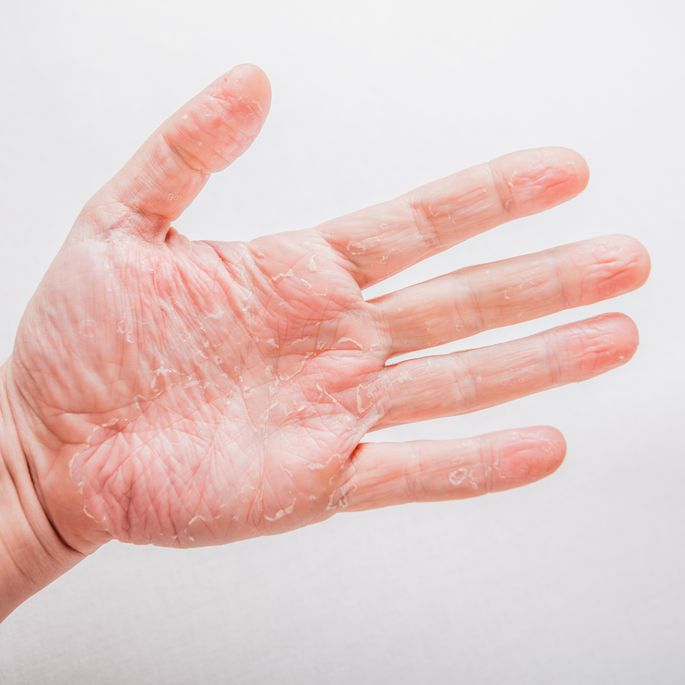 Kuidas sormed naevad valja nagu artriit