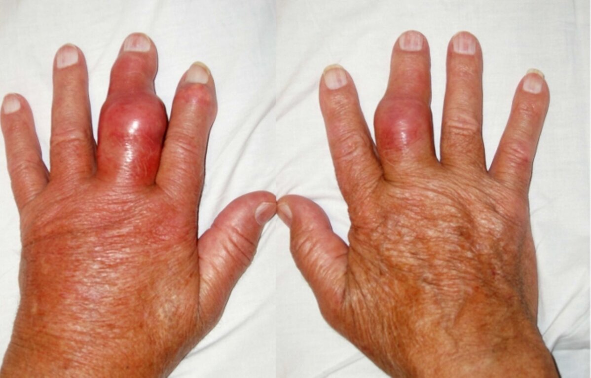 Punetus ja valu liigestes Folk viise artriidi sormede raviks