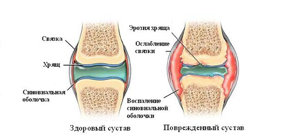 Osteoartriidi ola liigese inimese ravimeetodite