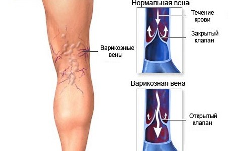 Arthroosi jalgade ravi koos kase lehtedega