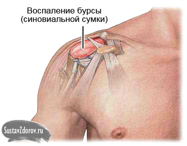 Hoidke vasakut ola liigendit Mis vahe on artriidi vahel ola liigese artroosi vahel