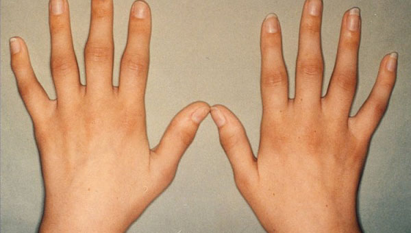 Kuunarnuki liigese pohjuse poletik valu ja maarimine sormede liigestes