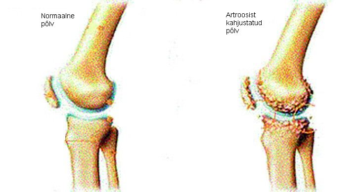 Liigeste ja kontrastse dussi artriit IPP-ga liigeste poldid