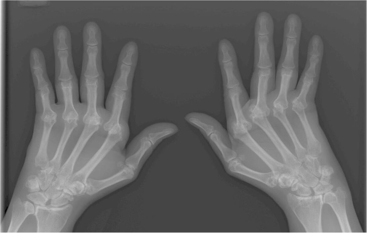 Mida sormede liigesed haiged Sormede harjade artroos