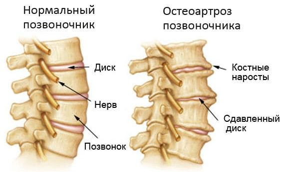 Osteokondroos harjade liigestes