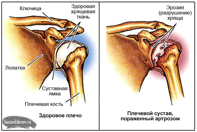 Osteoartriidi ola liigese inimese ravimeetodite