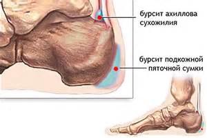 Poletikuliste lihaste ja liigeste ravi Artrosi jalgade ravi