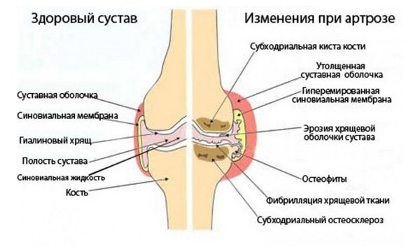 Rahvaviiside artroosi sormede raviks haiget ja murda liigeseid ja luud
