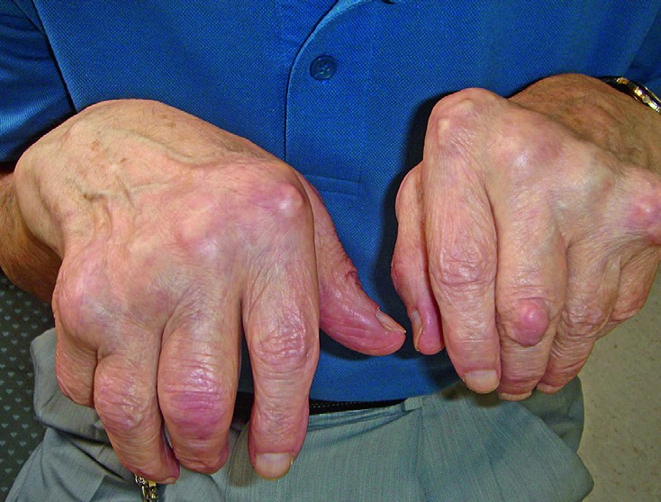 Sormede liigeste artriit artroos Kui liigese haigestub kanna