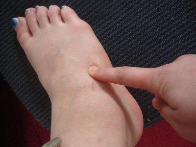 valu jala jalgsi kui kondimisravi Bursith kuunarnukite liigeste ravimeetodid