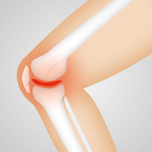 Jalu liigeste artroos on valus kontsad hommikul