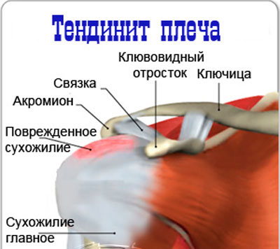 anesteesia liigeste artriidi anesteesia