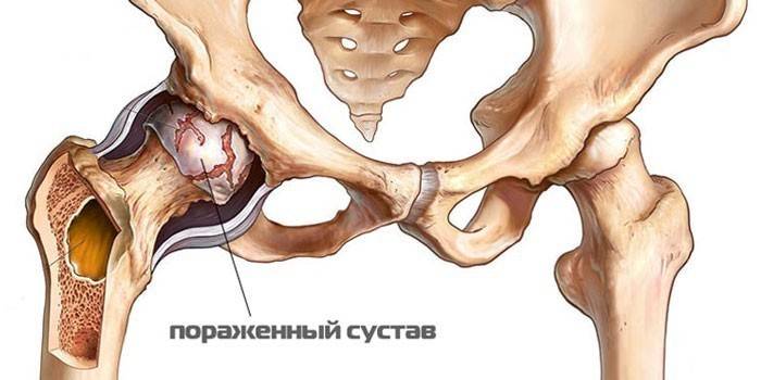 Jalgade keskosakonna liigeste arthroosi II etapp Juhtmete tootlemine Burjaatias