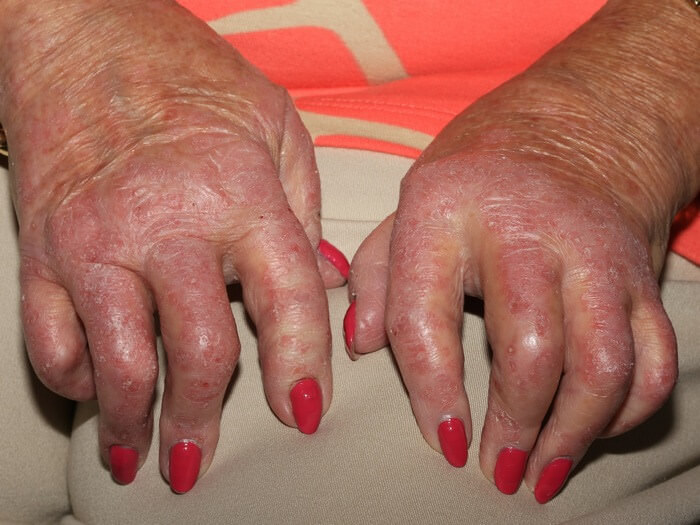 Folk meditsiin artriidi sormedes
