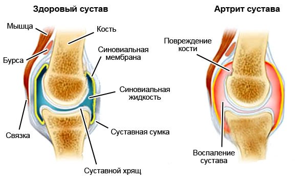 Endokriinse artropaatia haigused liigeste