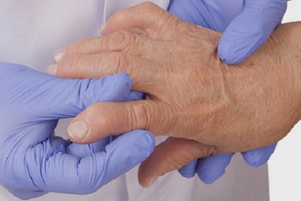 Folk meditsiin artriidi sormedes