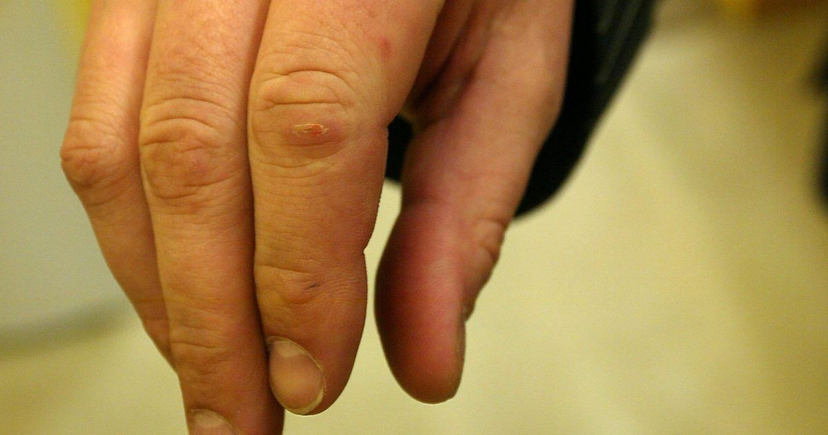 Kuidas sirgendada sormede kaed parast artriit valu liigestes jalgsi