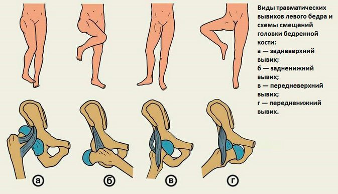 Kuidas eemaldada valu jalgsi Puha polve artroos