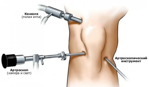 Osteokondroosi liigeste kontrollimine liigeste blokeerimine artroosi ajal