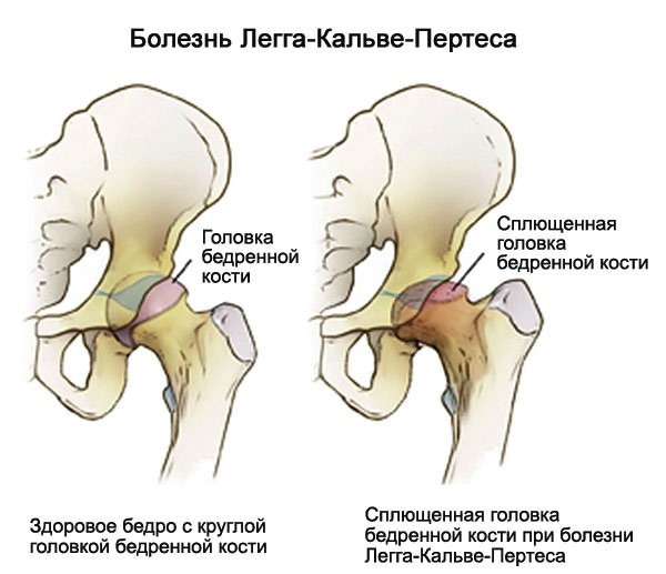 Endokriinse artropaatia haigused liigeste
