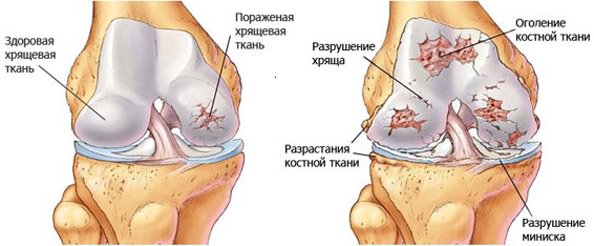 Koik artroosi ravi kohta valu jala puusaliigese kui raviks