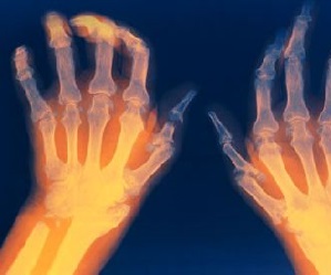 Artriidi liigesed haiget kate sormede liigestele, mida teha