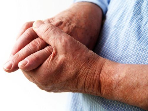 liigeste sormede artroos ravida Valud on liigeste liigesed