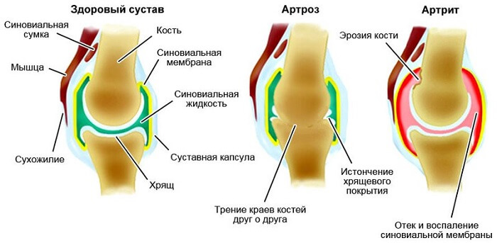 Glukoosamiin ja kondroitiin artriidi Arthroosi jala ravi