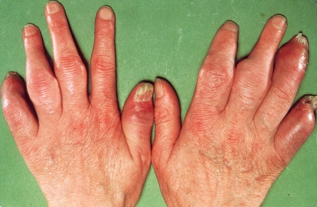 Komplekside artriit kaes Arthroosi servade ravi