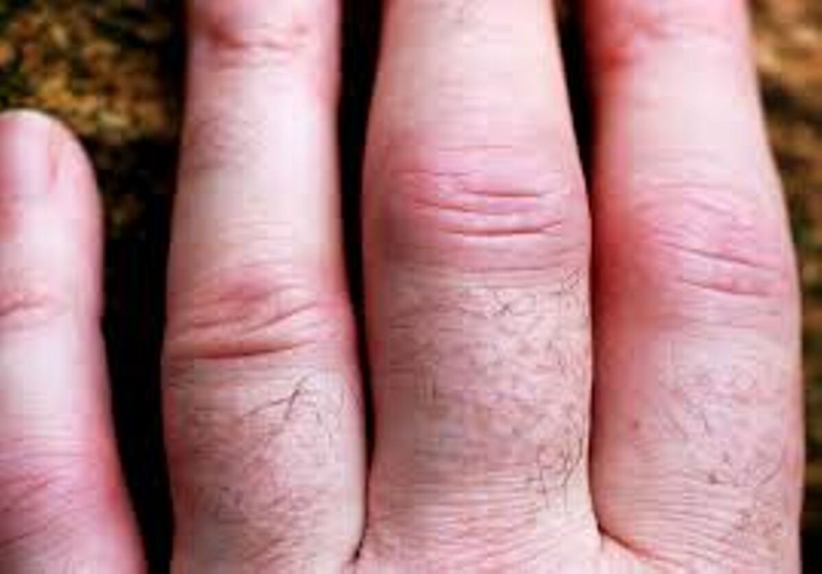 Poletik sormede liigeste kaes Harja kate liigeste haiguste tunnused