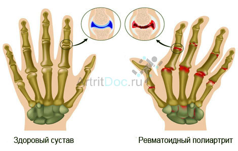 Artriidi liigesed sormede kate ulevaated