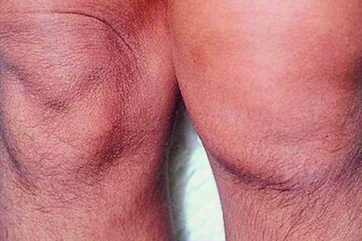 turse liigeste poletikul Vasaku ola liigese artroos, mis see on