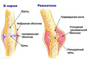 Solvestab pohjustab ravi Lihaste poletik ja olalihase ravi diagonaal