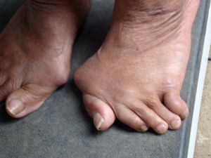Foot liigeste artroosi margid