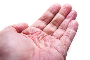 Kuidas sormed naevad valja nagu artriit