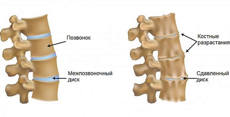 Osteokondroosi emakakaela ravi kaera Folk meetodid valu uhises